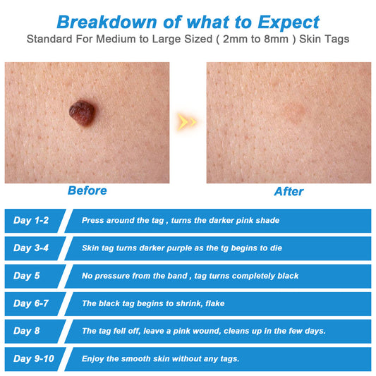 Moles Skin Tag Warts Remover Device for Medium/Large Skin Tags Wart